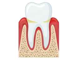 Gingivitis