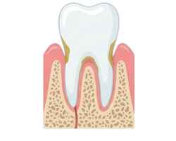 Mild Periodontitis