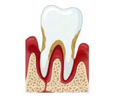 Severe Periodontitis