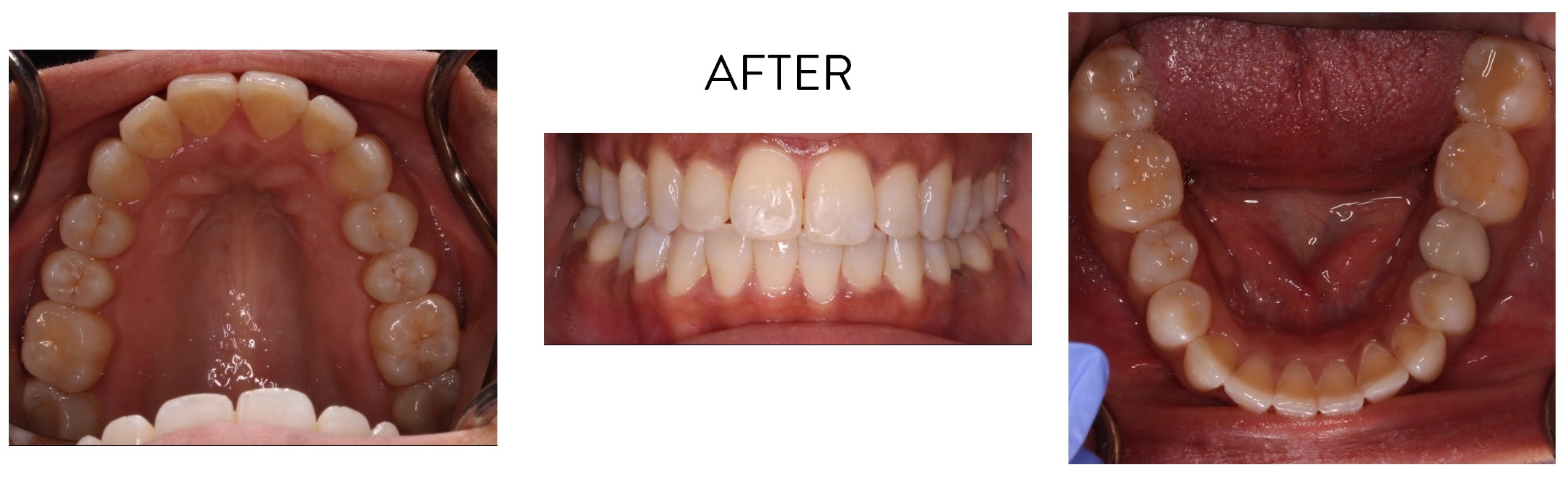 Invisalign Cost Edmonton, AB