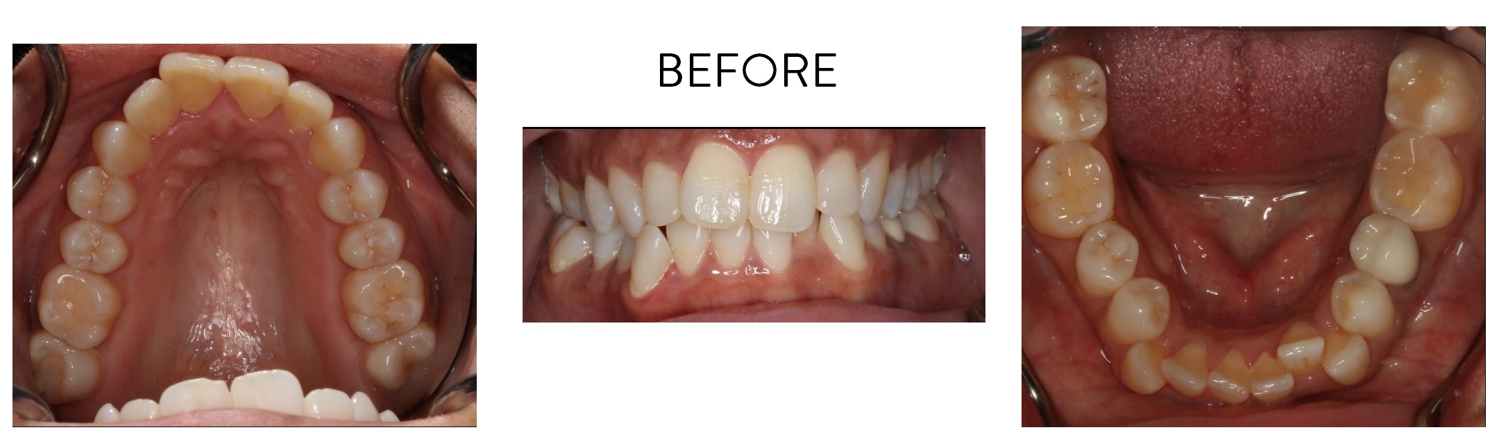 Invisalign | LAUREL DENTAL