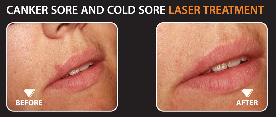 Cold Sore | LAUREL DENTAL