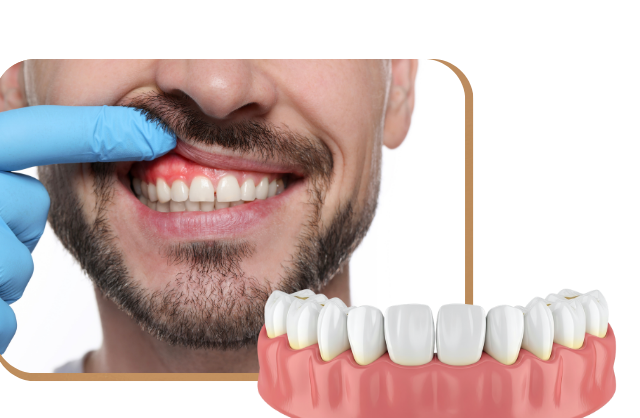 Gum Disease Treatment in Edmonton