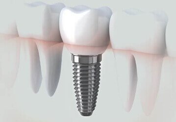 Dental Implants Edmonton
